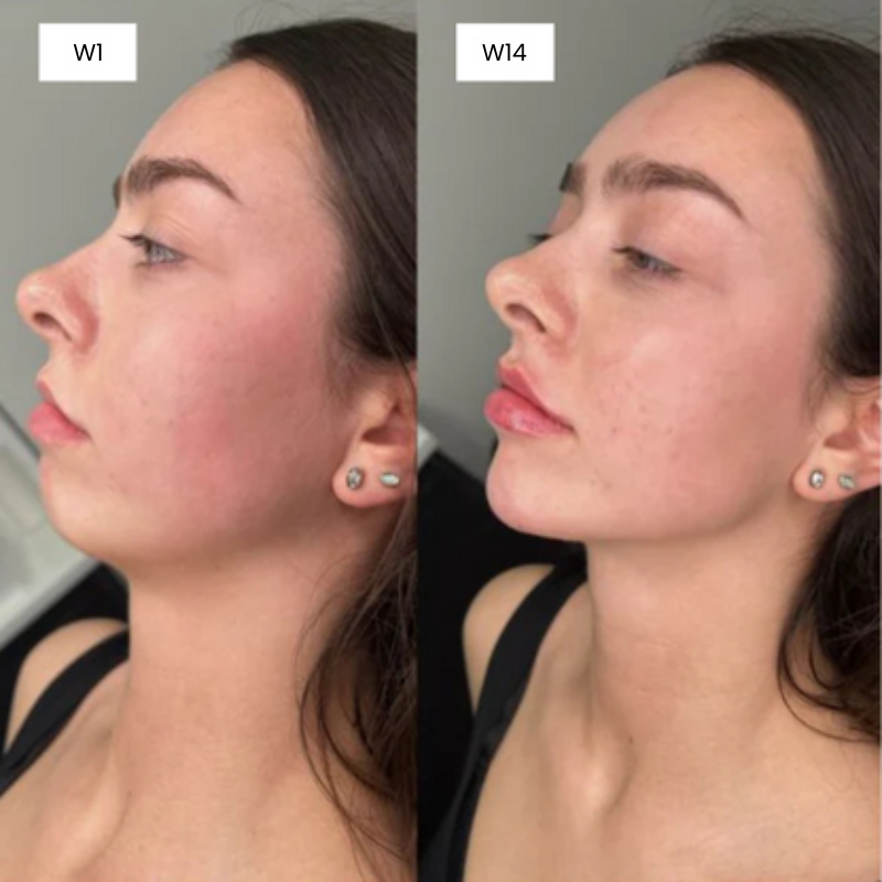 V-Line Fit Mask