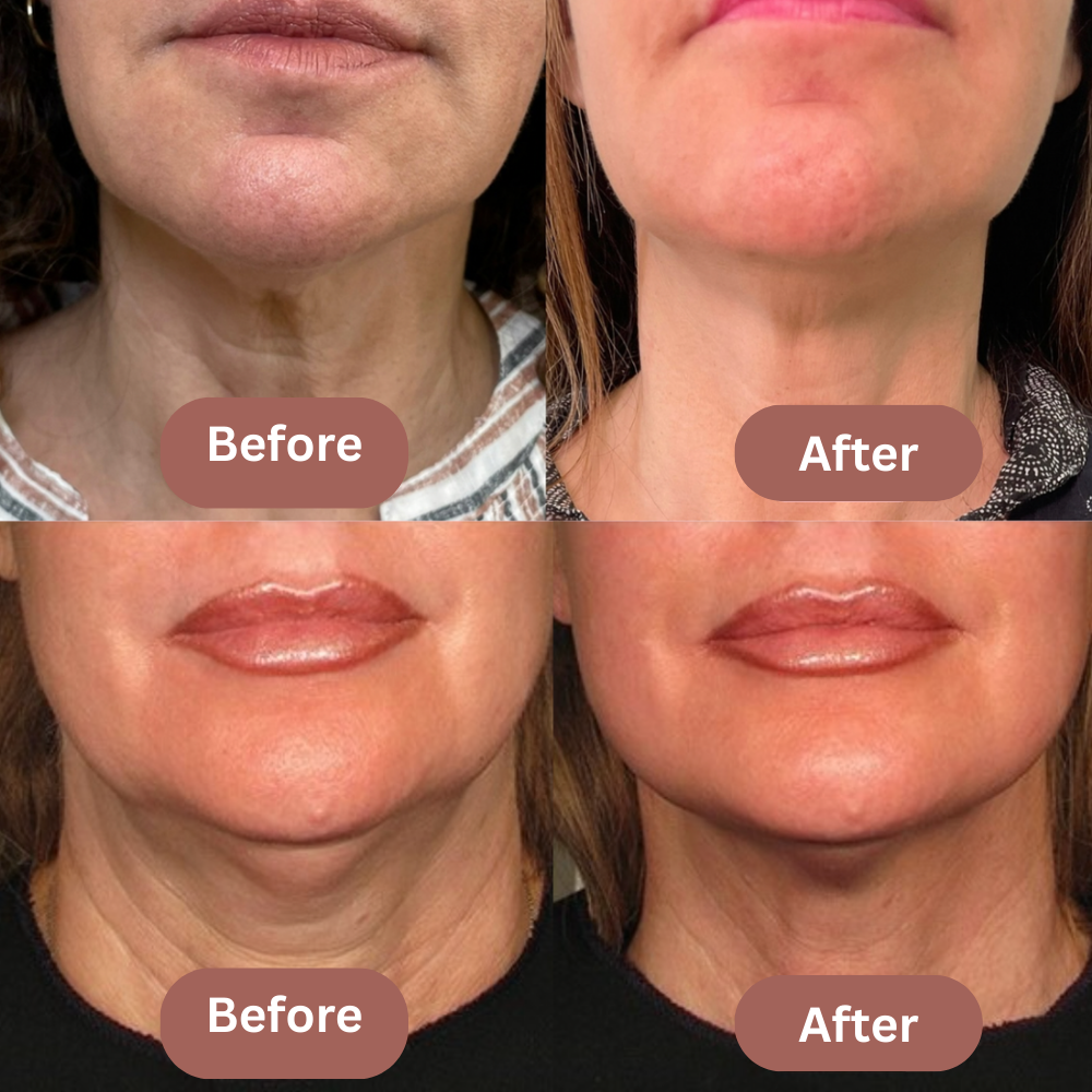 V-Line Fit Mask